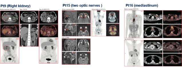 潘靜教授:為R/R T-ALL治療破局,供體來源CD14 CAR-T或可行!