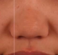 隆鼻再修復 高難度修復 美憬醫療修復基地 李炳澮教授