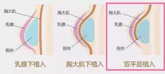 昆明想做假體隆胸,要怎么選擇?