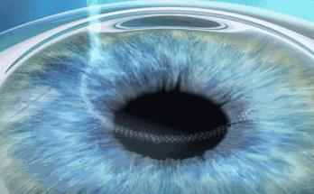 鄭州尖峰眼科:拉黑那個跟你說近視手術(shù)沒有風(fēng)險的人