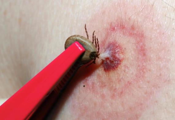 蜱蟲叮咬后如何處理?蜱蟲叮咬后潛伏期多長(zhǎng)時(shí)間