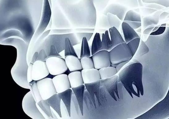 牙縫會不會因拔智齒變大?剛剛拔牙可不可以吃冰的東西?