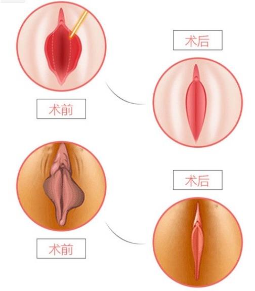成都小陰唇肥大怎么回事?陰唇肥大怎么辦?