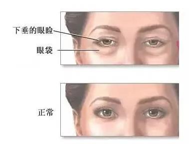 遇青春不開刀去眼袋,對癥“下藥”告別眼袋困擾!