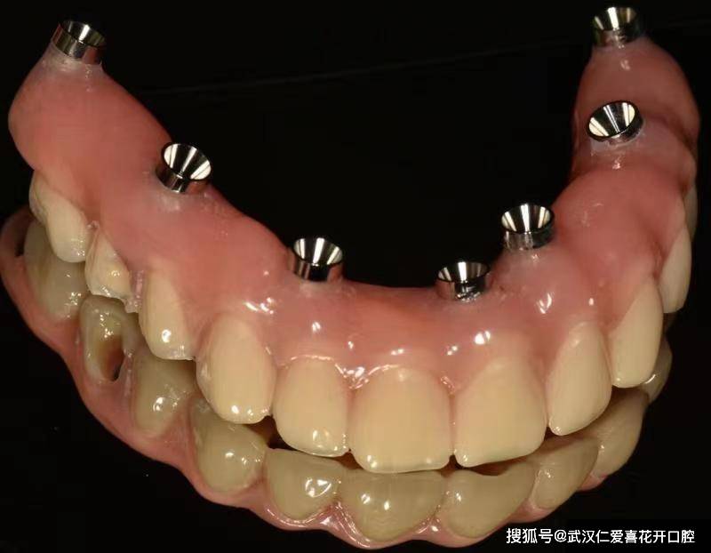 種植案例:80歲吳大爺“活動(dòng)假牙換種植牙”吃得好、嚼得爛、精神好!