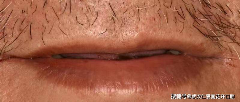 種植案例:80歲吳大爺“活動(dòng)假牙換種植牙”吃得好、嚼得爛、精神好!