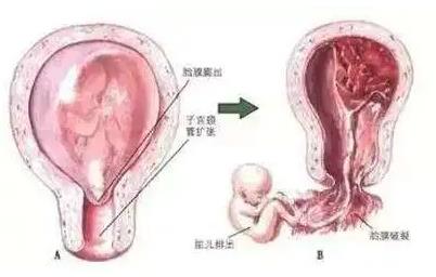 安太醫(yī)院陳鳳林 帶您了解晚期流產(chǎn)