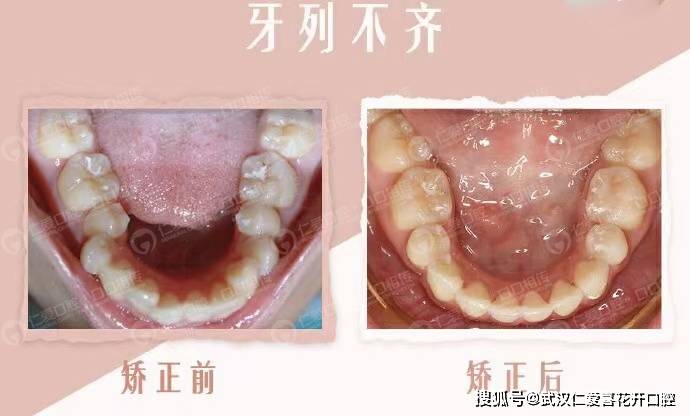 武漢仁愛口腔隱適美案例 正畸改善凸嘴,契合審美“E線”