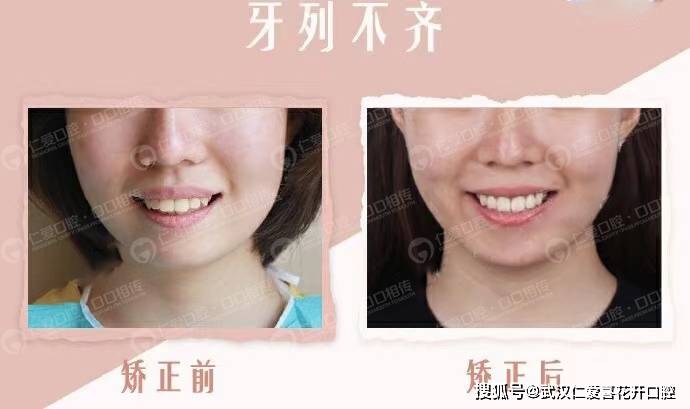 武漢仁愛口腔隱適美案例 正畸改善凸嘴,契合審美“E線”