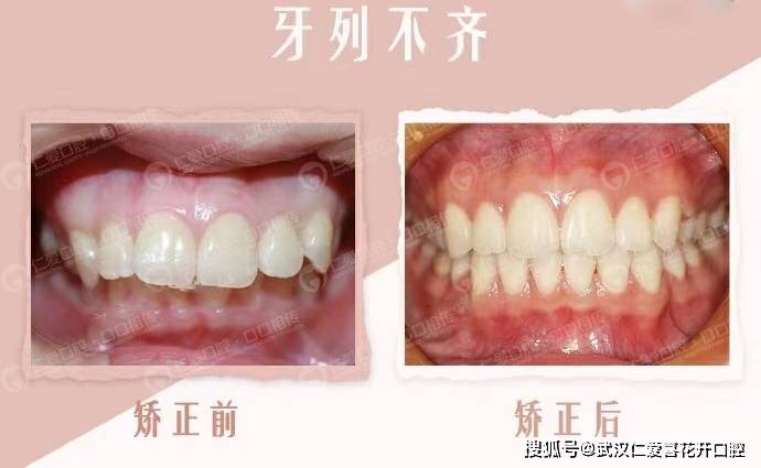 武漢仁愛口腔隱適美案例 正畸改善凸嘴,契合審美“E線”