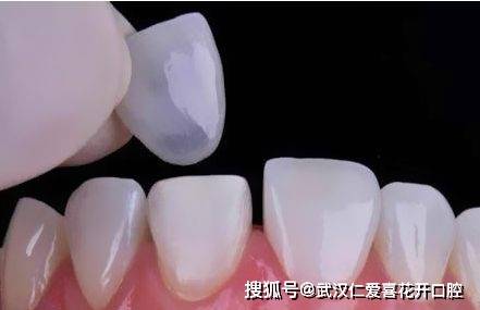 武漢仁愛口腔 牙齒貼面修復(fù),讓笑容從“齒”綻放!