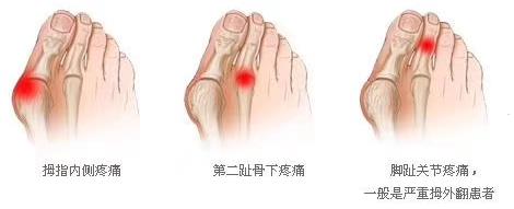 您關心的拇外翻知識,龍德剛主任帶您了解