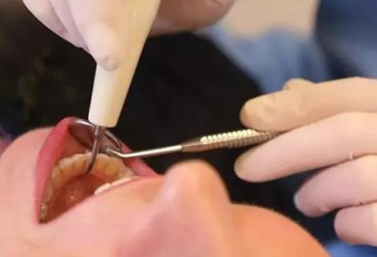 拔牙后怎么刷牙?拔牙后刷牙要注意什么事項