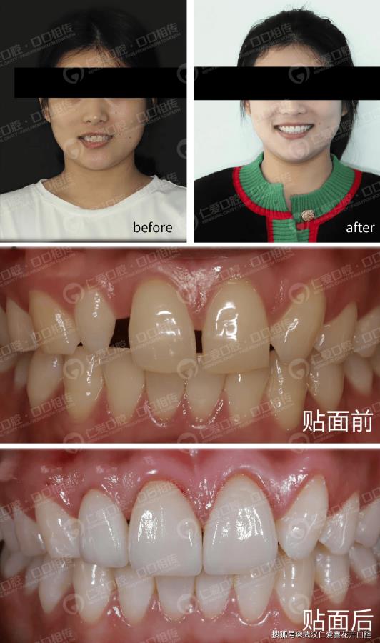 多年飽受牙黃牙丑苦惱,通過牙齒貼面——完美“蛻變”!