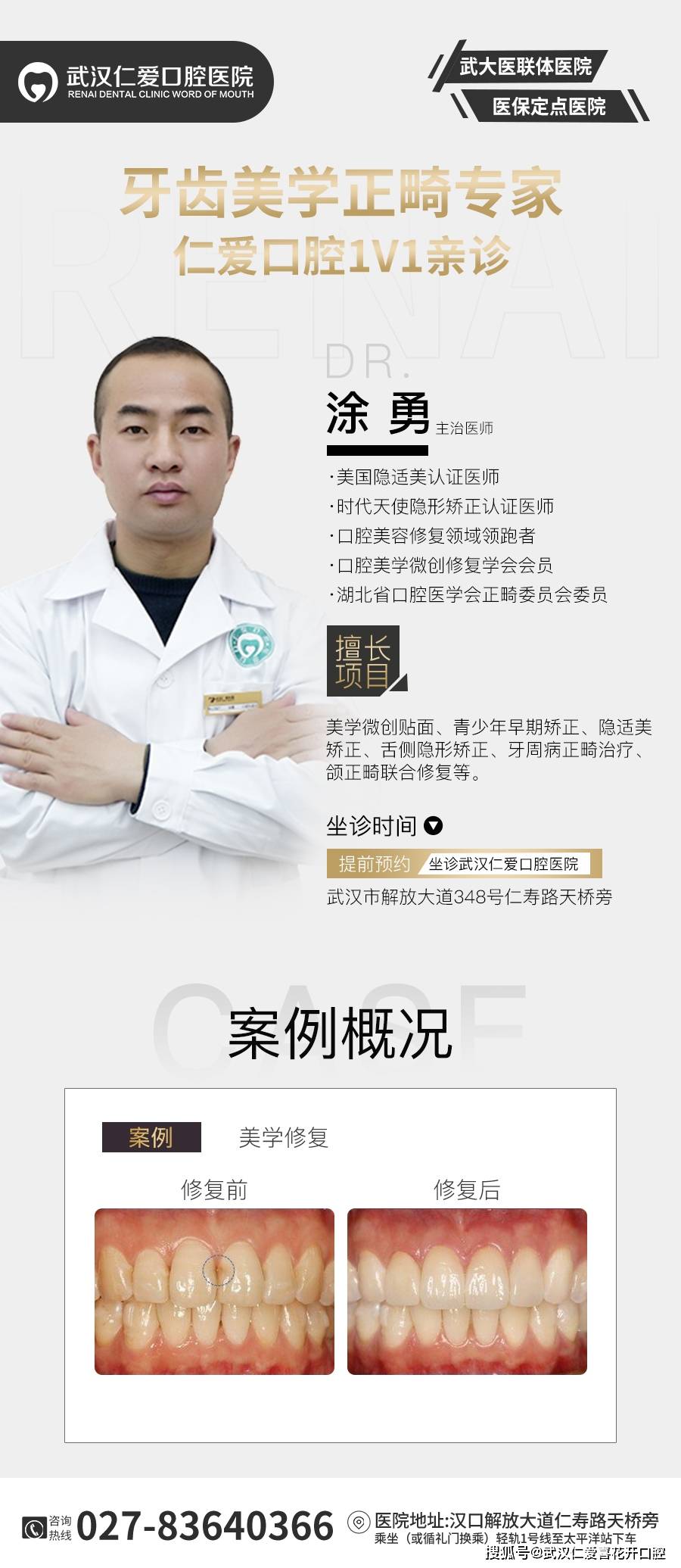 多年飽受牙黃牙丑苦惱,通過牙齒貼面——完美“蛻變”!