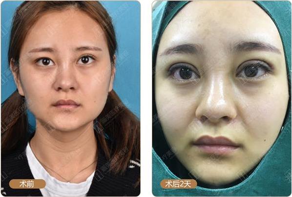 北京雙眼皮修復(fù)手術(shù)怎么收費(fèi)?