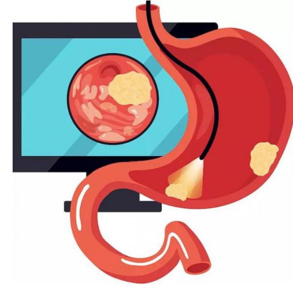 呼和浩特市東大肛腸醫院 胃里為什么會長息肉?日常如何預防胃息肉