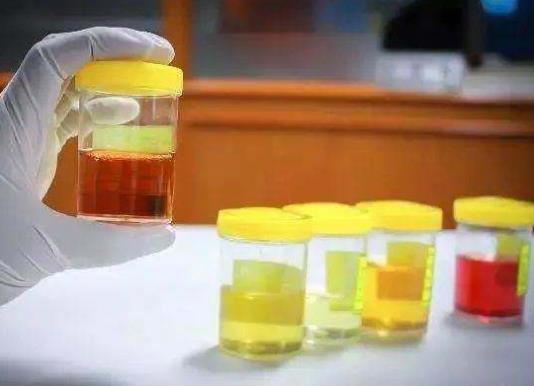 尿酸550不吃藥能降回正常值嗎?年輕人尿酸長(zhǎng)期500左右嚴(yán)重嗎