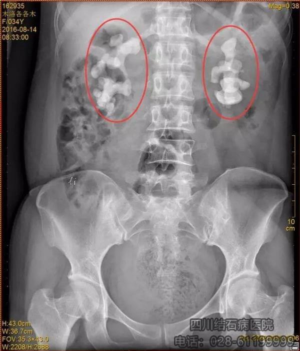 四川結(jié)石病醫(yī)院服務(wù)怎么樣 專(zhuān)業(yè)贏在優(yōu)質(zhì)服務(wù)