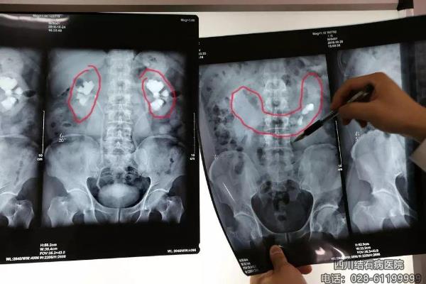 四川結(jié)石病醫(yī)院服務(wù)怎么樣 專(zhuān)業(yè)贏在優(yōu)質(zhì)服務(wù)