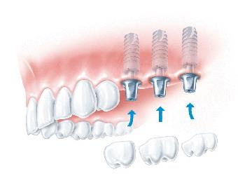 鄭州美奧口腔劉興國專業嗎 不斷取得技術上的突破