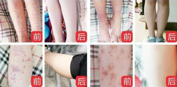 過敏性紫癜怎么治?【成都西南中醫(yī)醫(yī)院紫癜治療方法對比】