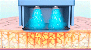 【武漢藝星整形醫(yī)院】一篇文章讓你讀懂抗衰神器“熱瑪吉”! 10.gif