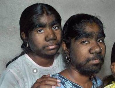 世界上體毛最長(zhǎng)的女人艾米麗·蘇珊,全身是毛如同猿猴