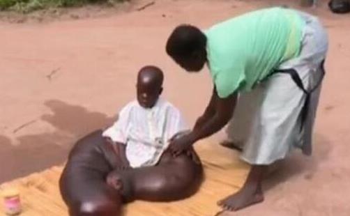 世界上最大最粗的腿 重216斤非洲8歲小孩腿長1.5米