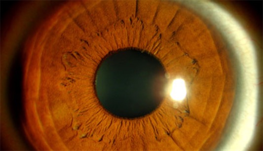 第一例成功的角膜移植手術 薩米埃爾比格為瞪羚移植角膜