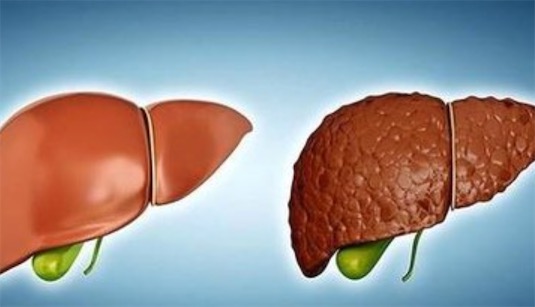 世界首例“一肝兩用”手術 2002年北大醫院創造奇跡