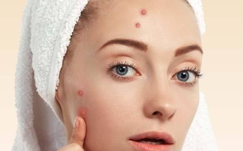 祛痘要正確 推薦5種日常祛痘小竅門