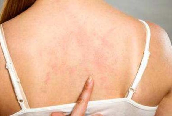 背部痤瘡很容易被忽視 推薦2種預防后背長痘痘的方法