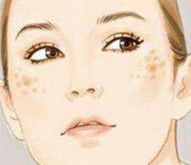 怎樣祛斑安全有效?用什么方法祛斑最徹底?