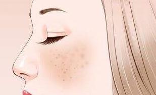 如何去除臉上的斑?最簡單有效祛斑的方法