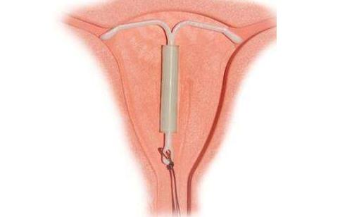 帶環懷孕的幾率是多少 帶環懷孕常見的6大癥狀