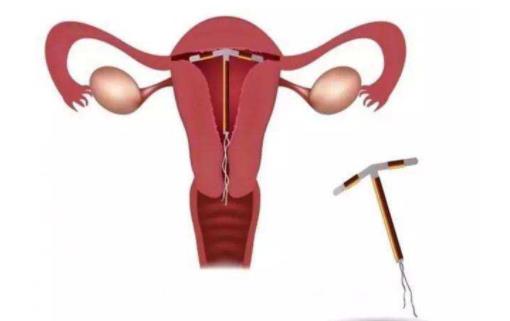 帶環懷孕的幾率是多少 帶環懷孕常見的6大癥狀