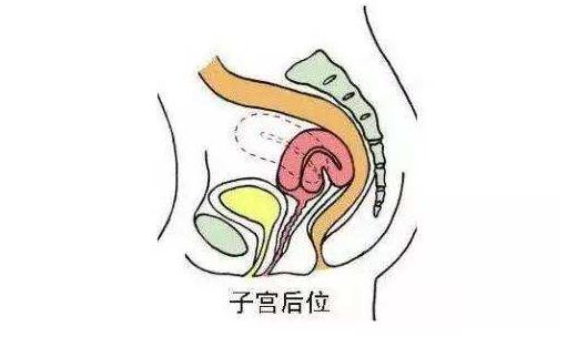 女性子宮后位影響受孕嗎 子宮后位懷孕的4個(gè)要點(diǎn)