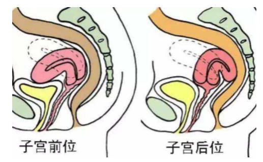 女性子宮后位影響受孕嗎 子宮后位懷孕的4個(gè)要點(diǎn)
