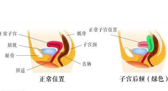 女性子宮后位影響受孕嗎 子宮后位懷孕的4個(gè)要點(diǎn)