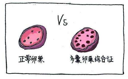 多囊卵巢如何受孕 多囊懷孕早期注意事項