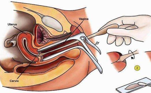 宮頸刮片結果怎么看 宮頸刮片的檢查項目