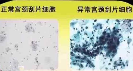 宮頸刮片結果怎么看 宮頸刮片的檢查項目