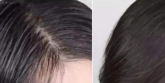 頭發(fā)油的原因有哪些?頭發(fā)油怎么辦?