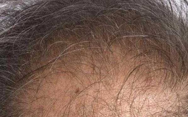 任何一種小原因都有可能引起脫發 脫發或是腎虛的信號