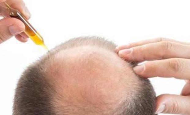 任何一種小原因都有可能引起脫發 脫發或是腎虛的信號