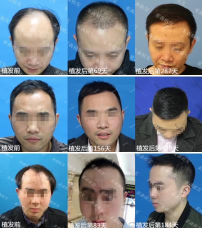 重慶萊森植發怎么樣 想要解決脫發禿頂