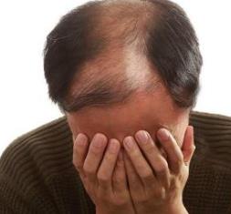 中年男人脫發(fā)主要有著這4大原因 推薦黑芝麻生發(fā)食療法