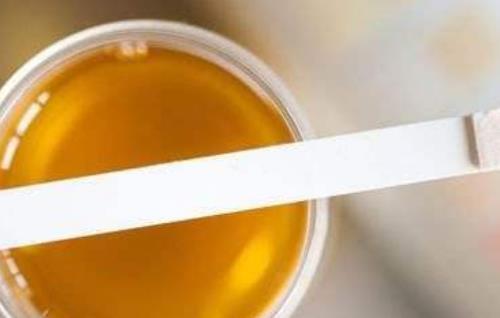 男性出現(xiàn)小便發(fā)黃的現(xiàn)象很危險(xiǎn) 主要由2種原因造成