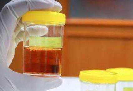 男性出現(xiàn)小便發(fā)黃的現(xiàn)象很危險(xiǎn) 主要由2種原因造成